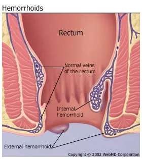 understandinghemorrhoidsbasics-hemorrhoids.jpg